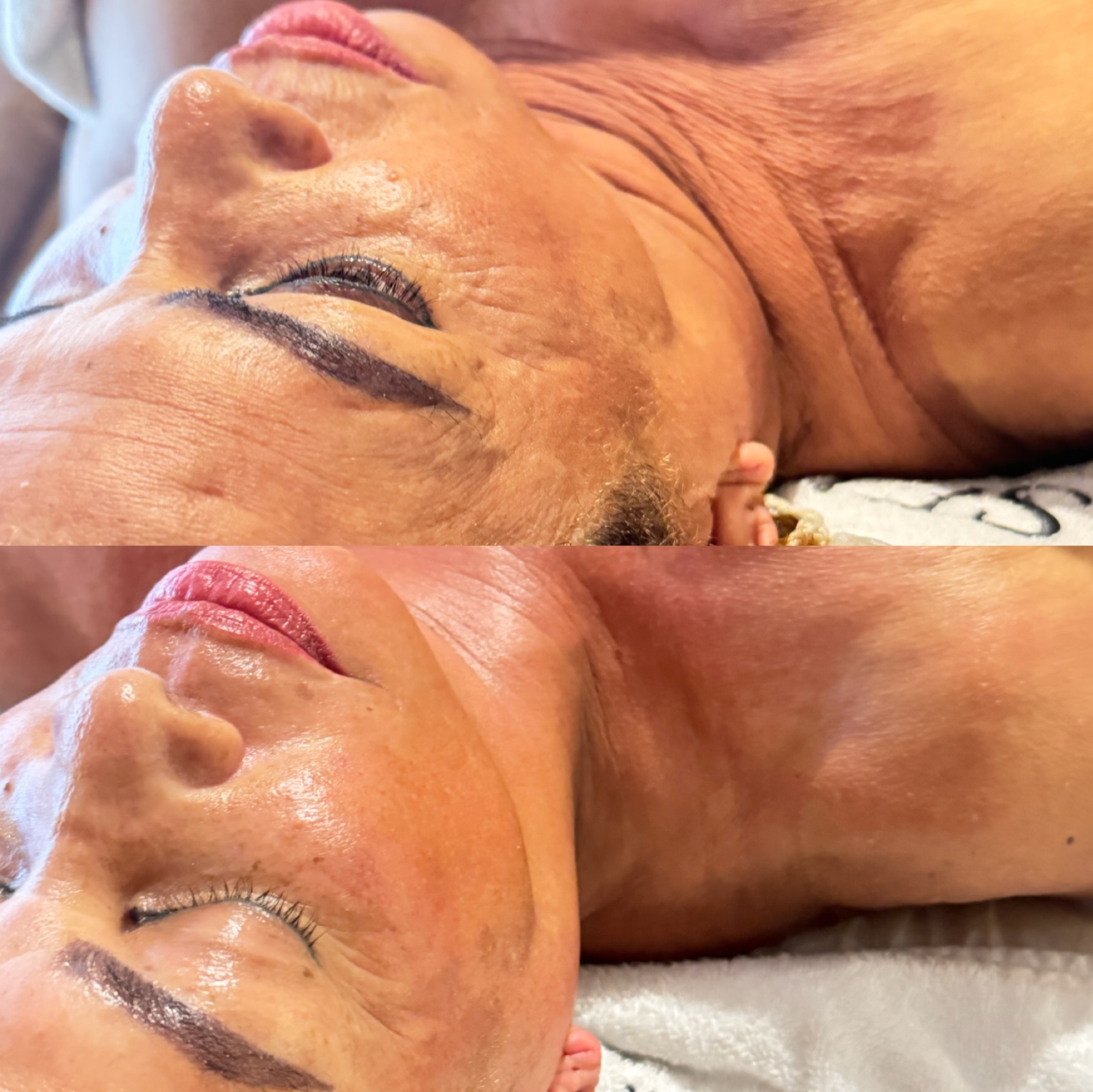 Antes y después mostrando la piel del cuello más firme tras el tratamiento