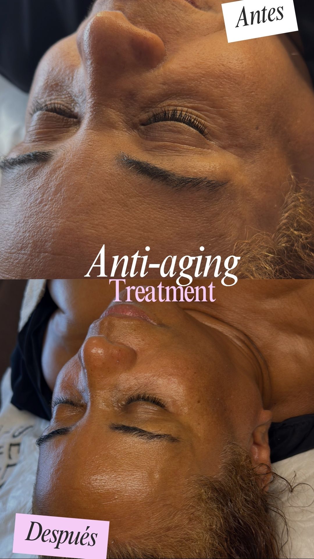 Antes y después de un tratamiento facial antiedad de rostro y cuello