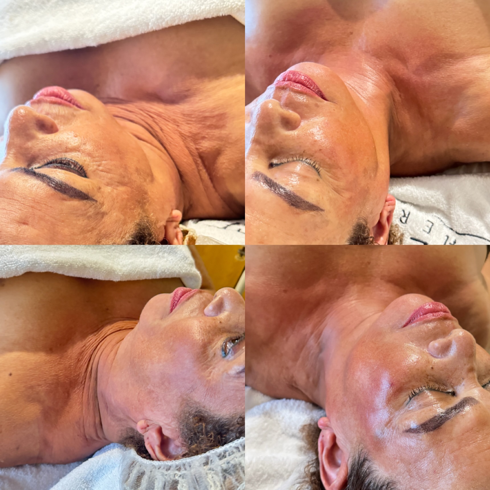 Secuencia de resultados de tratamiento facial de rostro y cuello